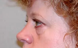 blepharoplasty before photo by michigan cosmetic surgery in southfield mi