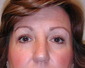 blepharoplasty after photo by michigan cosmetic surgery in southfield mi