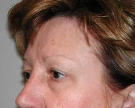 blepharoplasty before photo by michigan cosmetic surgery in southfield mi