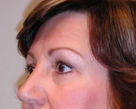 blepharoplasty after photo by michigan cosmetic surgery in southfield mi