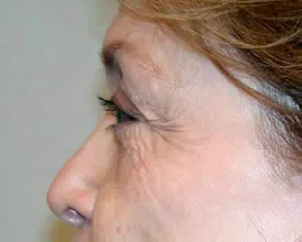 blepharoplasty before photo by michigan cosmetic surgery in southfield mi