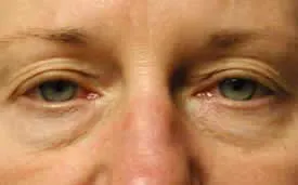 blepharoplasty before photo by michigan cosmetic surgery in southfield mi