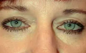 blepharoplasty after photo by michigan cosmetic surgery in southfield mi