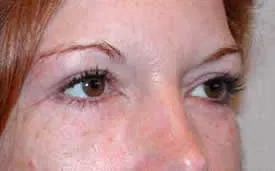 blepharoplasty after photo by michigan cosmetic surgery in southfield mi