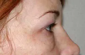 blepharoplasty before photo by michigan cosmetic surgery in southfield mi