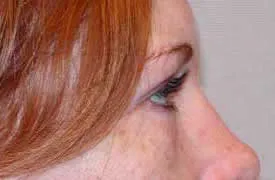 blepharoplasty after photo by michigan cosmetic surgery in southfield mi
