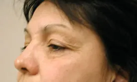 blepharoplasty before photo by michigan cosmetic surgery in southfield mi