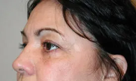 blepharoplasty after photo by michigan cosmetic surgery in southfield mi