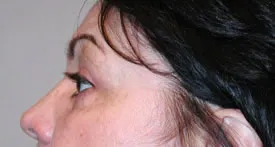 blepharoplasty after photo by michigan cosmetic surgery in southfield mi