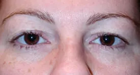 blepharoplasty before photo by michigan cosmetic surgery in southfield mi