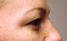 blepharoplasty after photo by michigan cosmetic surgery in southfield mi