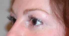 blepharoplasty after photo by michigan cosmetic surgery in southfield mi