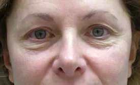 blepharoplasty before photo by michigan cosmetic surgery in southfield mi