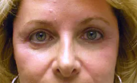blepharoplasty after photo by michigan cosmetic surgery in southfield mi