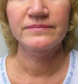 facelift after photo by michigan cosmetic surgery in southfield mi