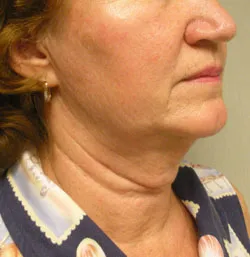 facelift before photo by michigan cosmetic surgery in southfield mi
