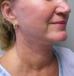 facelift after photo by michigan cosmetic surgery in southfield mi