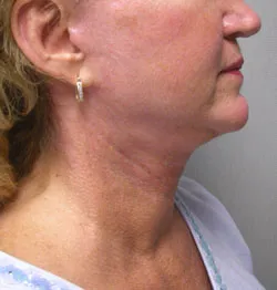 facelift after photo by michigan cosmetic surgery in southfield mi