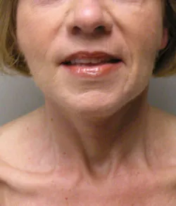 facelift after photo by michigan cosmetic surgery in southfield mi