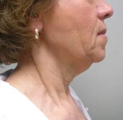facelift before photo by michigan cosmetic surgery in southfield mi