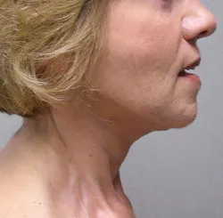 facelift after photo by michigan cosmetic surgery in southfield mi