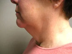 facelift before photo by michigan cosmetic surgery in southfield mi