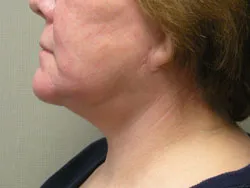 facelift after photo by michigan cosmetic surgery in southfield mi