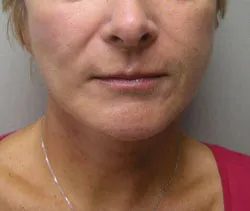 facelift after photo by michigan cosmetic surgery in southfield mi