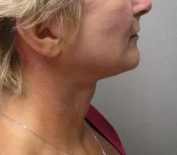 facelift after photo by michigan cosmetic surgery in southfield mi