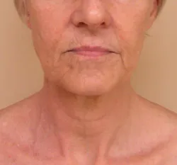 facelift before photo by michigan cosmetic surgery in southfield mi