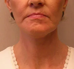 facelift after photo by michigan cosmetic surgery in southfield mi