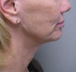 facelift before photo by michigan cosmetic surgery in southfield mi