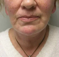 facelift after photo by michigan cosmetic surgery in southfield mi