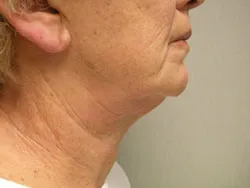 facelift before photo by michigan cosmetic surgery in southfield mi