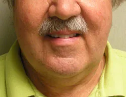 facelift before photo by michigan cosmetic surgery in southfield mi