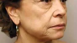 facelift before photo by michigan cosmetic surgery in southfield mi