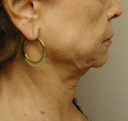 facelift before photo by michigan cosmetic surgery in southfield mi