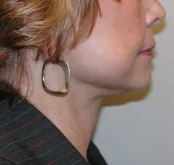 facelift after photo by michigan cosmetic surgery in southfield mi