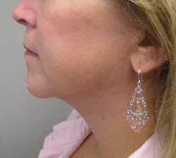 facelift after photo by michigan cosmetic surgery in southfield mi