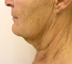 facelift before photo by michigan cosmetic surgery in southfield mi