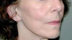 facelift before photo by michigan cosmetic surgery in southfield mi