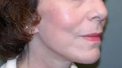 facelift after photo by michigan cosmetic surgery in southfield mi