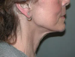 facelift before photo by michigan cosmetic surgery in southfield mi