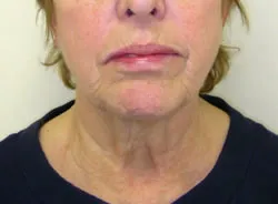 facelift before photo by michigan cosmetic surgery in southfield mi