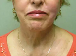facelift after photo by michigan cosmetic surgery in southfield mi