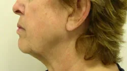 facelift before photo by michigan cosmetic surgery in southfield mi