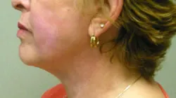 facelift after photo by michigan cosmetic surgery in southfield mi