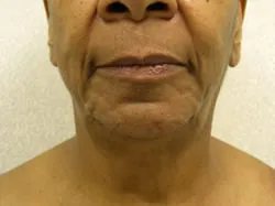 facelift before photo by michigan cosmetic surgery in southfield mi