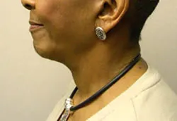 facelift after photo by michigan cosmetic surgery in southfield mi