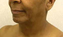 facelift before photo by michigan cosmetic surgery in southfield mi